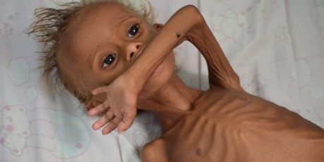 Yemen_Hunger crisis Yemen_Hunger crisis